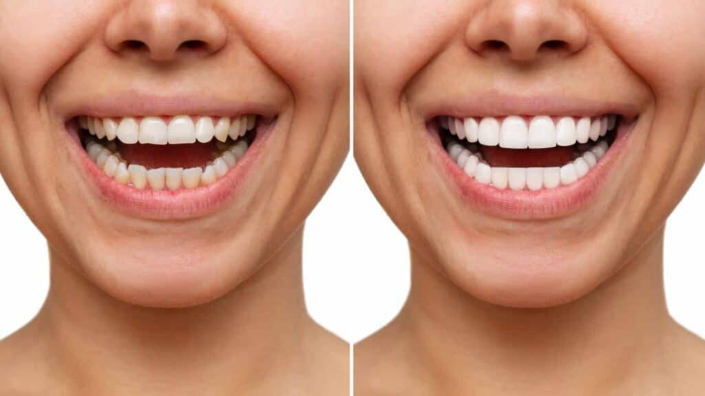 Instant results whitening